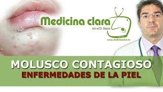 Enfermedades piel Molusco contagioso pápulas perladas granos en niños [upl. by Rehtul18]