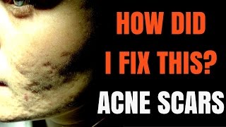 How to treat acne scars  Dermatologist explains [upl. by Fernandes]