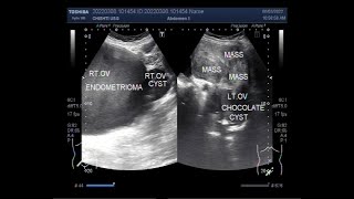 What is SIMPLE OVARIAN CYST amp HEMORRHAGIC OVARIAN CYST [upl. by Nicola]