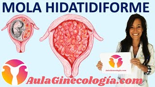 ENFERMEDAD TROFOBLÁSTICA GESTACIONAL MOLA HIDATIDIFORME  Ginecología y Obstetricia [upl. by Nive144]