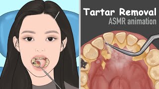 ASMR Tartar removal animation  Dental Scaling  Satisfying [upl. by Aillimat420]