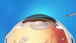 What is Refractive Lens Exchange Surgery [upl. by Shamrao407]