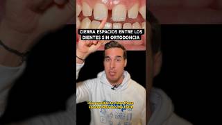 Cerrar DIASTEMAS o ESPACIOS entre los DIENTES sin ortodoncia [upl. by Tuttle]