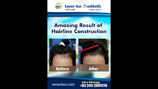 Female Hairline Reconstruction [upl. by Penelope429]