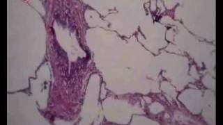 HistoPathology Emphysema د عبد الرحمن خليفة [upl. by Eissoj924]