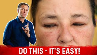 How to Fix the Swollen Face Facial Puffiness and Puffy Eyes – DrBerg [upl. by Akcirre75]