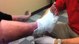 Treatment of an Ulcer with an Unna Boot [upl. by Animaj]