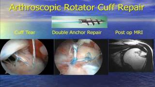 Sports Medicine Update 2010 Rotator Cuff Injuries Presented by Dr Stephan Yacoubian [upl. by Ninel]