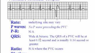 ECG Premature Ventricular Complexes PVC [upl. by Sivam]