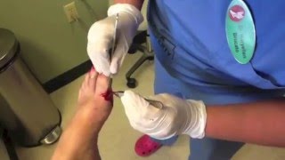 Surgical Removal of Ganglion Cyst [upl. by Eceinert]