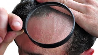 Plaque psoriasis on face pictures pics images mild symptoms skin rash [upl. by Arihsa]