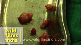 Freshly extracted cysts from the cancer infected breast [upl. by Einaj]