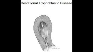 Gestational Trophoblastic Disease [upl. by Sevik]