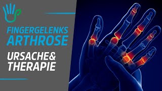 Fingergelenksarthrose  Ursache Therapie amp Übungen [upl. by Aylatan685]