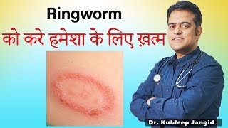 Ringworm Treatment दाद  Fungal Infection Infection Best Treatment  Best Homeopathic Doctor [upl. by Murray]