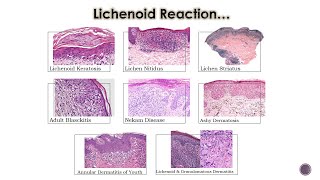 8 Lichenoid Dermatoses 2 [upl. by Nohsyar]