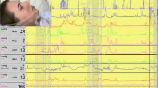 Video 1  Performing esophageal manometry [upl. by Germin]