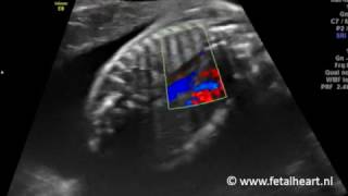 Fetal heart Academy  Heterotaxy 1 vena azygos and aodesc color Doppler [upl. by Lyns]