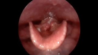 Laryngoscopy False Cord Fry Throat Singing Highlights [upl. by Boyes]