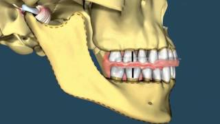 Avance mandibular  Ortodoncia [upl. by Nickey]