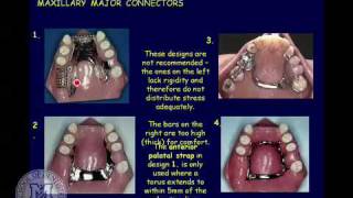 How Braces Work Elements of the orthodontic treatment and its role © [upl. by Derraj]