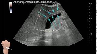 Adenomyomatosis of the Gallbladder [upl. by Gobert]