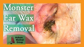 Monster Ear Wax Removal Brings New Life to JOKESTER Patient  Auburn Medical Group [upl. by Nnairac]