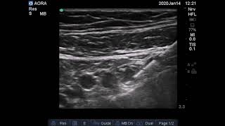 Lateral infraclavicular nerve block [upl. by Gardener]