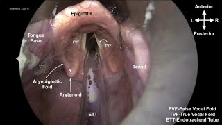 DIAGNOSTIC LARYNGOSCOPY Procedure of diagnostic laryngoscopy ent procedure [upl. by Raveaux]