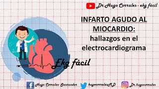 INFARTO AGUDO DE MIOCARDIO Hallazgos electrocardiográficos [upl. by Derzon319]