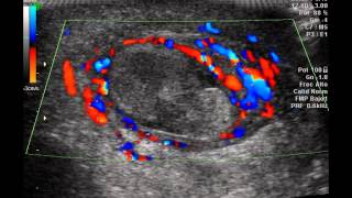 Epididimo orquitis Doppler color [upl. by Aierdna]