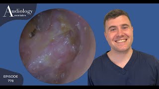 EAR WAX REMOVAL WITH AGGRAVATED EARDRUM EP778 [upl. by Farleigh]