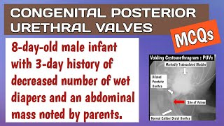 Posterior Urethral Valves MCQs  VCUG and Transurethral Valve Ablation Vesicostomy [upl. by Wilden]