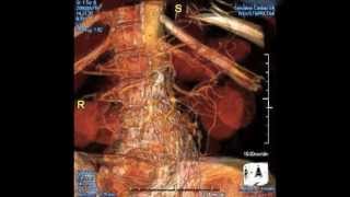 Iliac Artery Aneurysm Repair [upl. by Orabla]