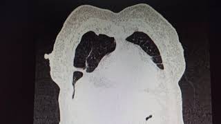 Multiple cavitary lesions with surrounding consolidation and ground glass opacification in left lung [upl. by Triplett]