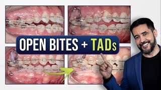 Anterior Open Bite  Adult Patients  TADs [upl. by Boyd]