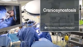 What Is Craniosynostosis 6 of 9 [upl. by Kus]