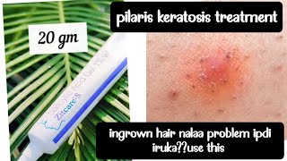 zitcare s salicylic acid gel review  pilaris keratosis treatment  acne [upl. by Sirac]