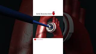 Aortic dissection Stent grafting cardiology shorts [upl. by Nyrol885]