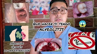 ¿INFECCIÓN DESPUES DE UNA EXTRACCION QUE HACER SI TENGO ALVEOLITIS [upl. by Dolloff]