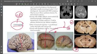 5 Lissencephaly [upl. by Nairdad116]