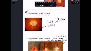 practical ophthalmology 2 [upl. by Galliett]