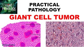 GIANT CELL TUMOR BONE Pathogenesis Clinical features amp Morphology [upl. by Ibson992]