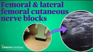 Femoral and lateral femoral cutaneous nerve blocks [upl. by Asaeret]