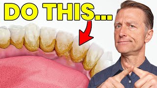 The 1 Top Remedy for Dental Plaque TARTAR [upl. by Repohtsirhc905]