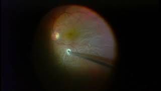 Vitrectomy for Retinal Detachment  Macula is Detached [upl. by Naret]