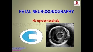 Fetal Neurosonography – Holoprosencephaly [upl. by Casper]