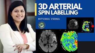 3D ARTERIAL SPIN LABELLING  MITUSHA VERMA  NEW MR TECHNIQUES  ADVANCED STROKE IMAGING  PENUMBRA [upl. by Ateuqram]