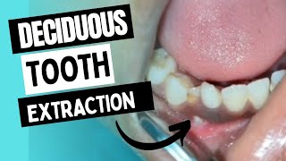 Deciduous Tooth ExtractionMilk Tooth ExtractionDeciduous Canine Extraction [upl. by Livvie129]