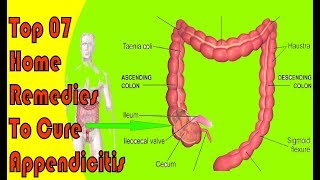 Top 07 Home Remedies To Cure Appendicitis [upl. by Eeliab]